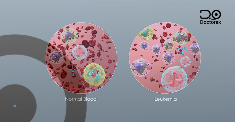 سرطان الدم - اللوكيميا