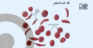 تراكم خلايا الدم المنجلية