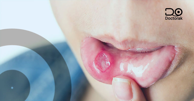 علاج قرح الفم