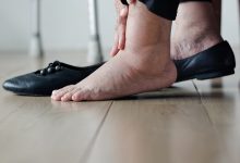 طرق علاج تورم القدمين