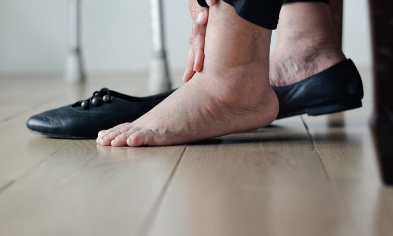 طرق علاج تورم القدمين