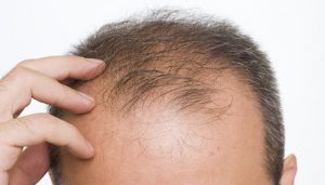 الصلع الوراثي من اسباب تساقط الشعر
