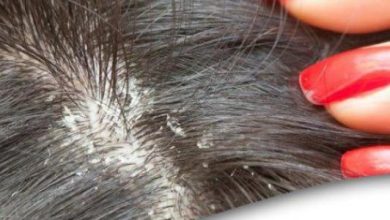 ما هي طرق علاج قشرة الشعر في المنزل؟