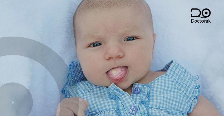 ما هو علاج فطريات اللسان عند الرضع؟