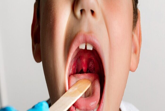 أعراض اللوز واسباب تكرار التهاب اللوزتين عند الاطفال
