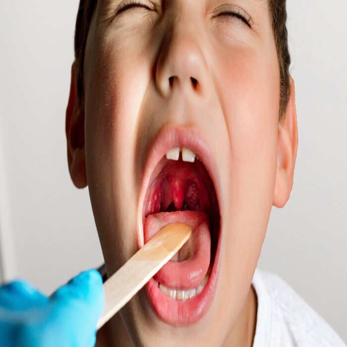 أعراض اللوز واسباب تكرار التهاب اللوزتين عند الاطفال