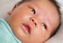 علامات الشفاء من الصفراء عند الرضع