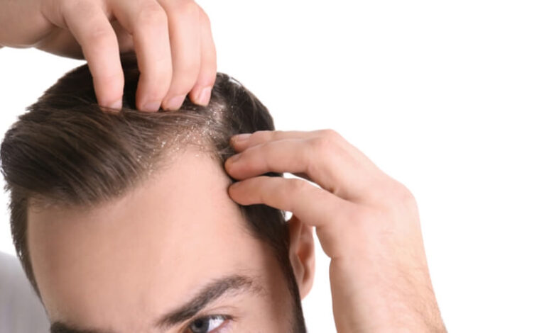علاج قشرة الرأس والحكة