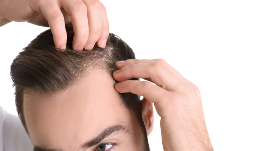 علاج قشرة الرأس والحكة
