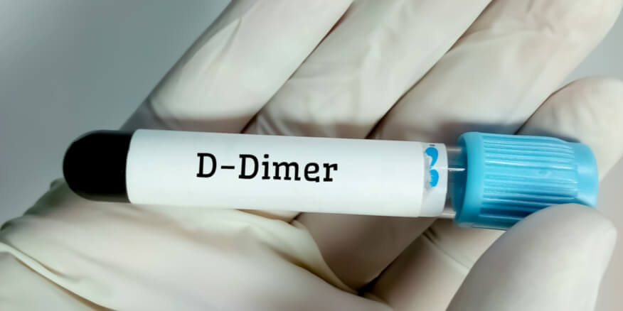 تحليل d dimer