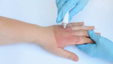 علاج سحري للحروق