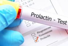 تحليل prolactin