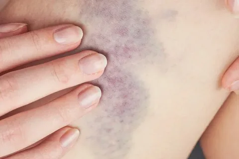 أسباب ظهور بقع زرقاء على جسم المرأة بعد النوم