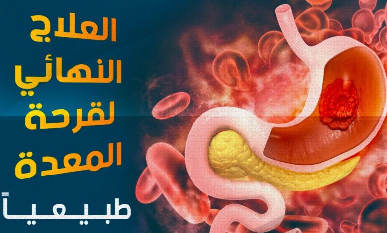 علاج قرحة المعدة