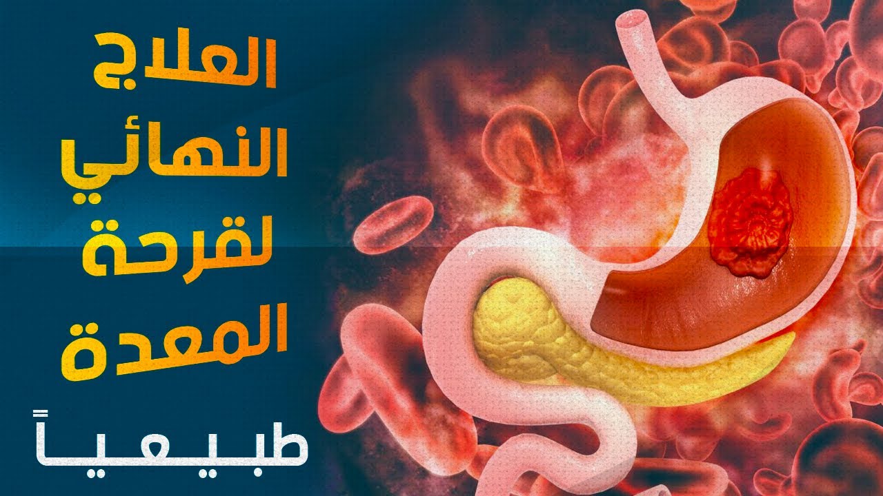 علاج قرحة المعدة